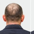 The Ultimate Guide: A Comparison Of Hair Restoration Services At Beauty Salons And Medical Spas In Westlake Village, CA