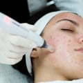 Get The Best Results: Microneedling Pen Before Your Beauty Salon Treatment