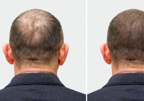 The Ultimate Guide: A Comparison Of Hair Restoration Services At Beauty Salons And Medical Spas In Westlake Village, CA