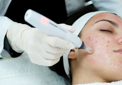 Get The Best Results: Microneedling Pen Before Your Beauty Salon Treatment